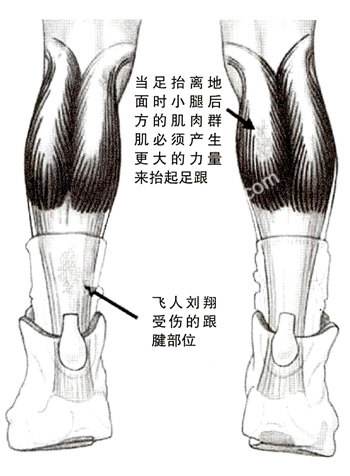 跑步引起的跟腱炎怎么矫正,跑步的隐患