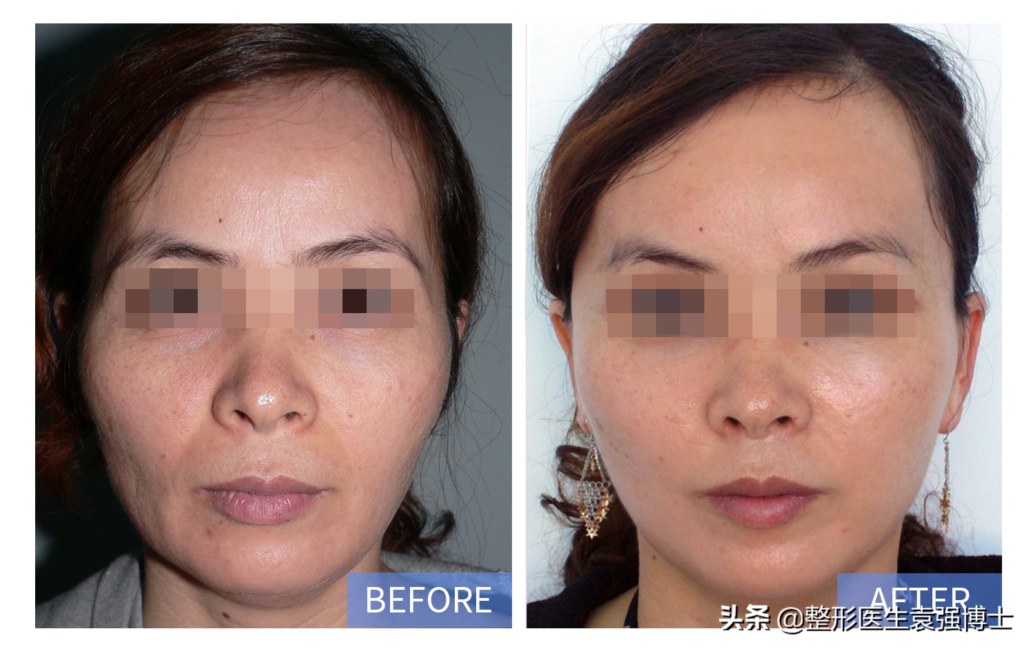 25岁有法令纹怎么改善,每天三分钟去掉法令纹的小技巧