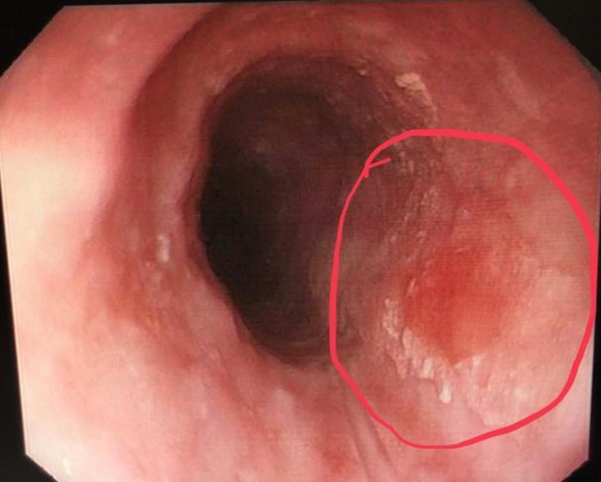 食管癌早期做胃镜能查到吗,食管癌通过胃镜可以检查出来吗