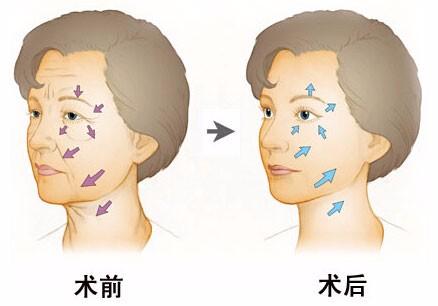 打玻尿酸可以让人变漂亮吗,打玻尿酸真的能减肥吗