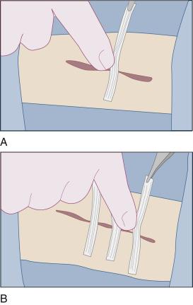 手割破了用创可贴吗,刚刚割伤后的疤痕如何消除
