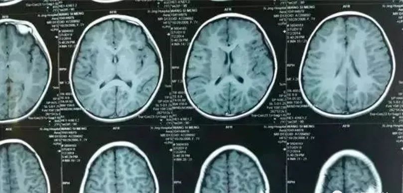 八个月婴儿颅骨骨缝,新生儿颅骨下有血肿严重吗