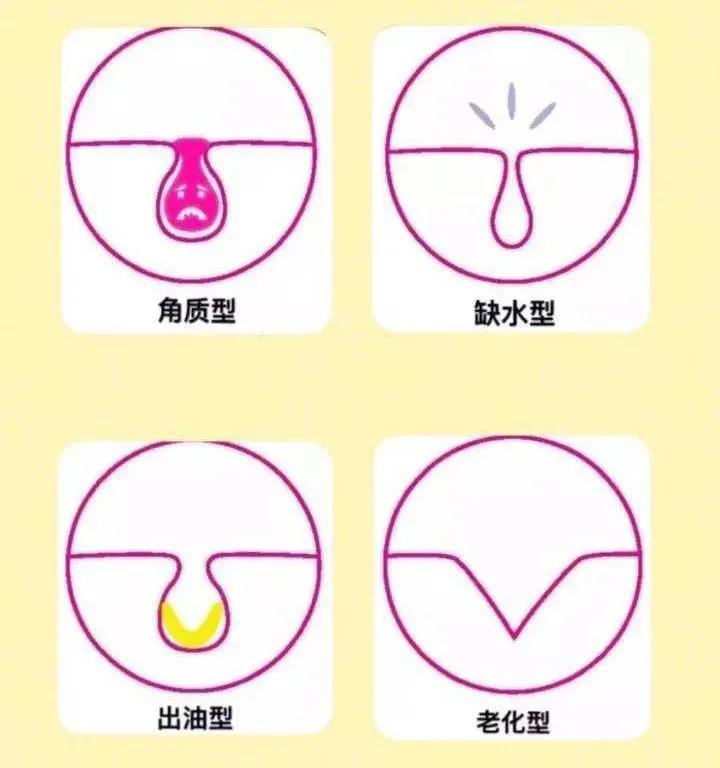 听说你毛孔大到可以放芝麻，该怎么办？