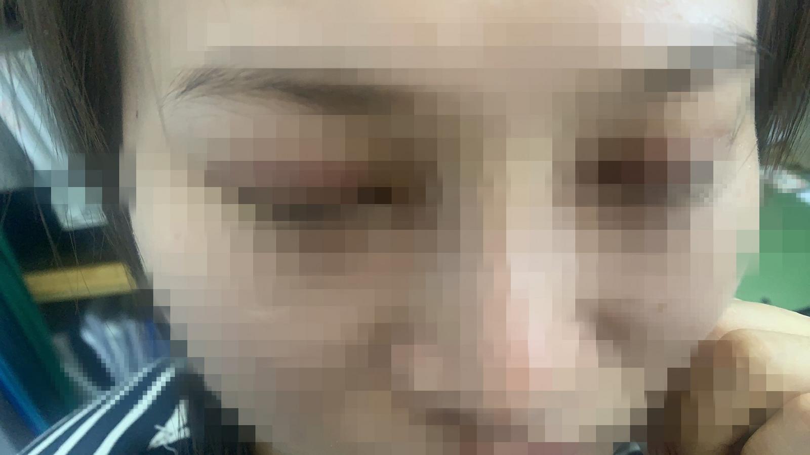 “你用手掰回来啊！”深圳女子整容歪鼻，医生竟让她自行掰正