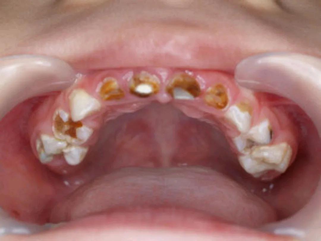 孩子全麻拔牙补牙有风险吗,小孩拔牙全麻有危险吗