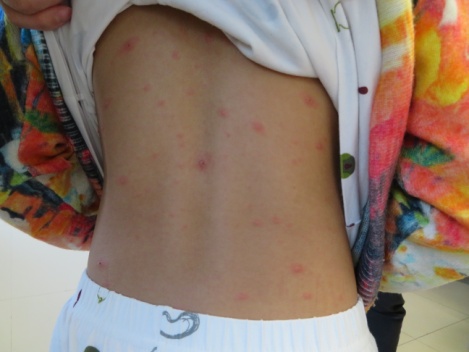 发热性皮疹,成人发热伴皮肤出疹