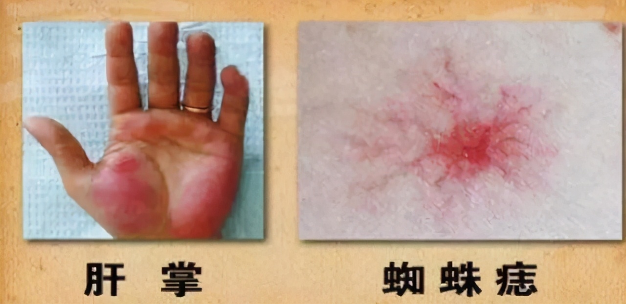 酒精肝到肝癌一般几年,酒精肝转成肝癌还能活多久