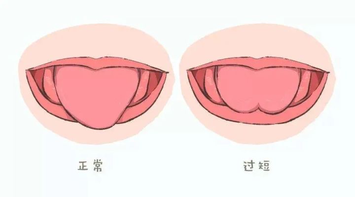 小孩发音不标准剪舌系带,舌系带短影响发音到底剪不剪