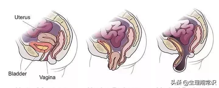 阴道里脱出块“肉”!