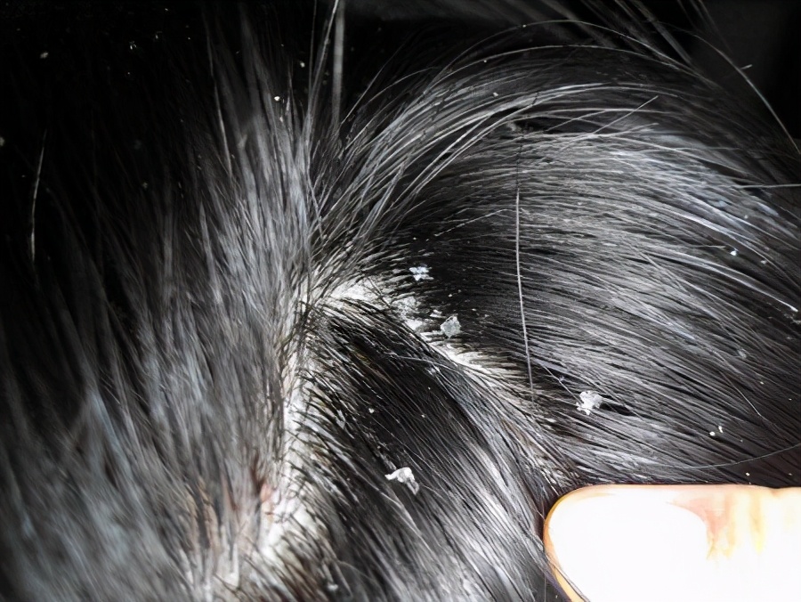 螨虫造成的头皮屑怎么治,头皮屑里有没有螨虫