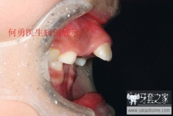 正畸医生如何指定方案的,正畸医生怎么说