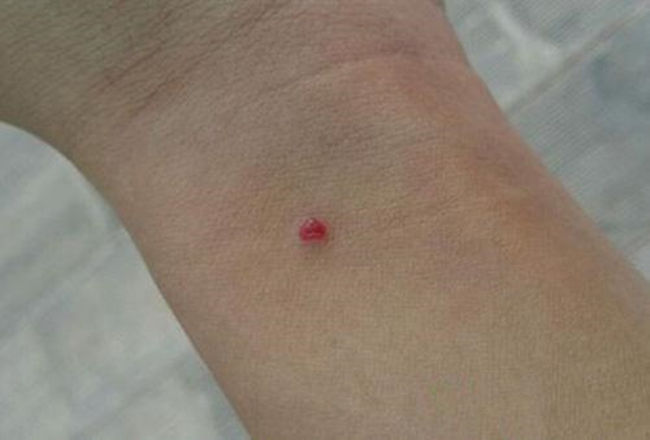 身上出现小红点一定要注意,身上出现小红点是什么原因引起的