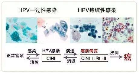 tct没问题hpv18却是阳性,tct阴性hpv18阳性患癌几率