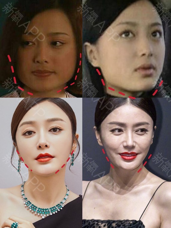 那些削骨的女明星怎么样了,哪些明星承认削骨了