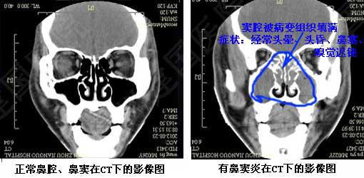 小孩有鼻窦炎用什么药比较好,儿童鼻窦炎的治疗和护理