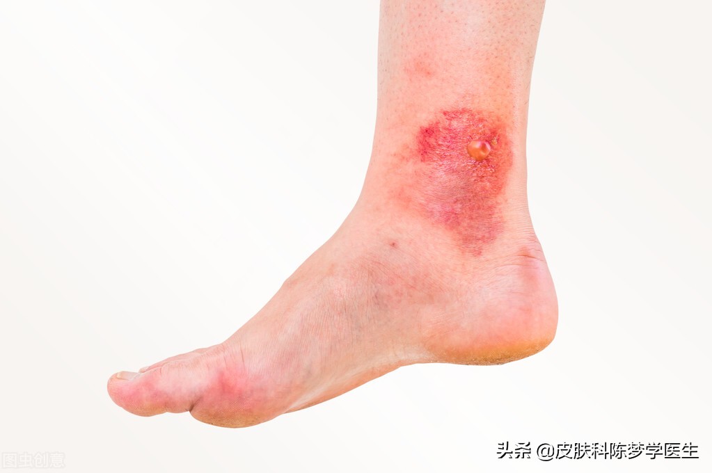 皮肤上长红斑、脱屑，是不是得了牛皮癣？