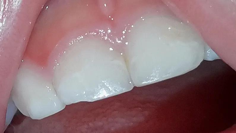 小孩子吃糖就一定会蛀牙吗,为什么小孩子吃糖会蛀牙