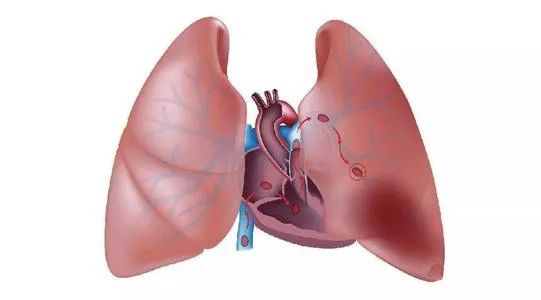 静默的杀手,沉默的杀手静脉血栓