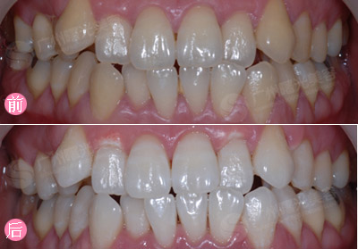 美白牙齿冷光仪真的靠谱,牙齿美白修复你真的可以了解一点