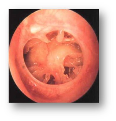 耳膜穿孔是微创手术好还是传统好,耳膜穿孔如何能免开刀低费用修补