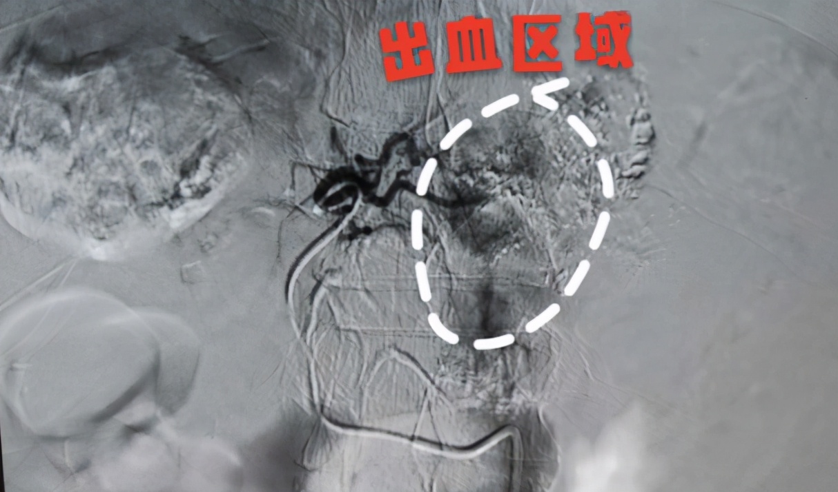 中西结合治疗肝癌效果如何,肝癌肿瘤破裂出血怎么治疗