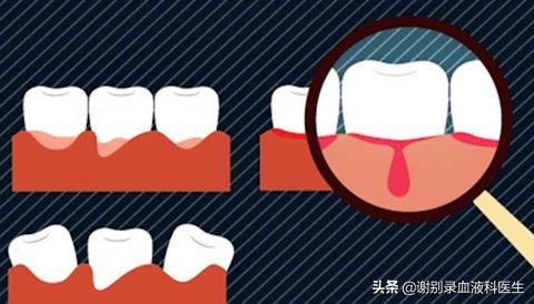 血友病牙龈肿泡怎么办,血友病牙龈出血怎么回事