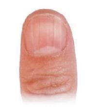 如何从手指甲上看病症,如何从指甲看疾病