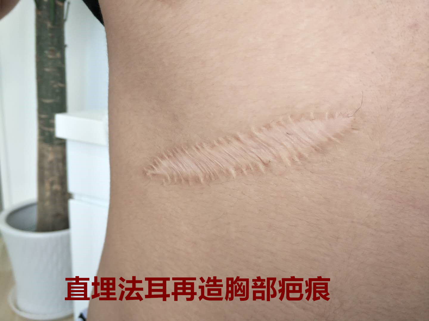 小耳畸形要留还是不留,小耳畸形最新治疗方法