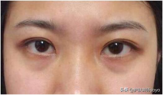 眼霜哪种好用不长脂肪粒,哪些眼霜抹了不长脂肪粒