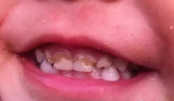 孩子门牙有点黑色是什么原因,儿童门牙发黑是什么原因引起的