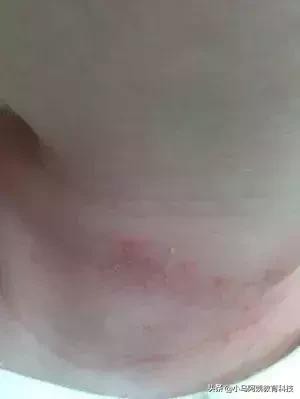 婴儿多久才会不怕热不会长痱子,小孩身上长痱子怎么消除