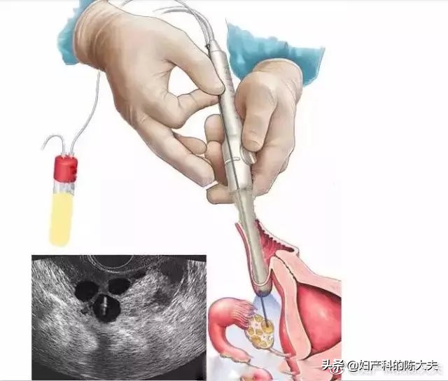 女性试管成功率多大,试管婴儿女性要遭受多大的罪