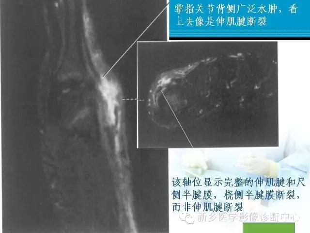 单只手指磁共振,手指用磁共振能做出来结果吗