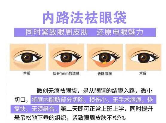 如何消除眼袋呢,如何消除眼袋浮肿