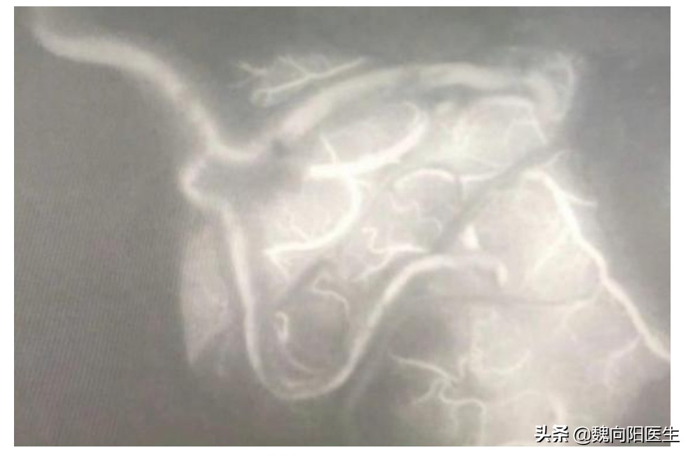 烟雾导致脑梗塞的治疗,烟雾病引起脑梗后能做手术吗