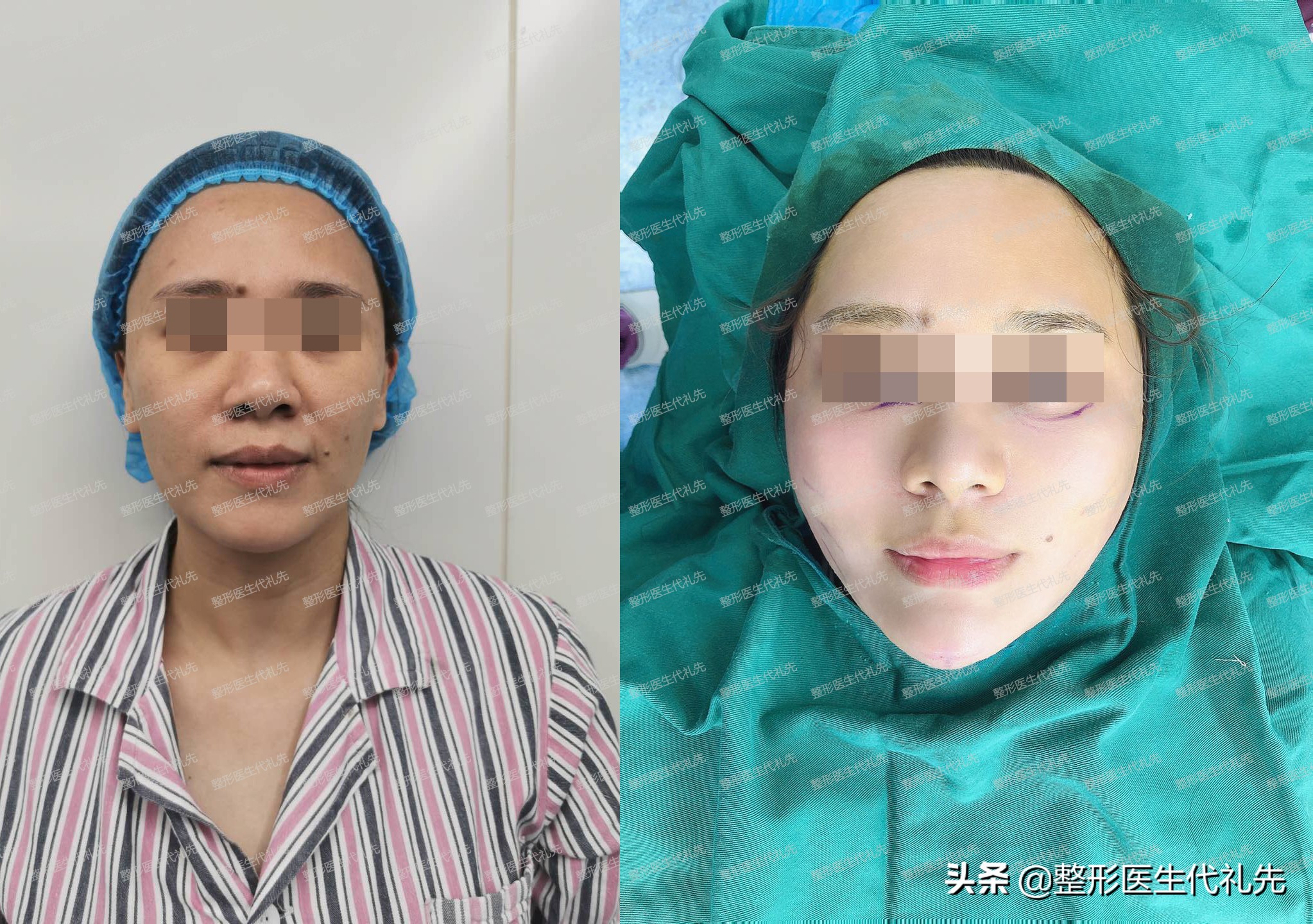 从整形医生的角度来聊一聊形成法令纹的原因以及改善方案