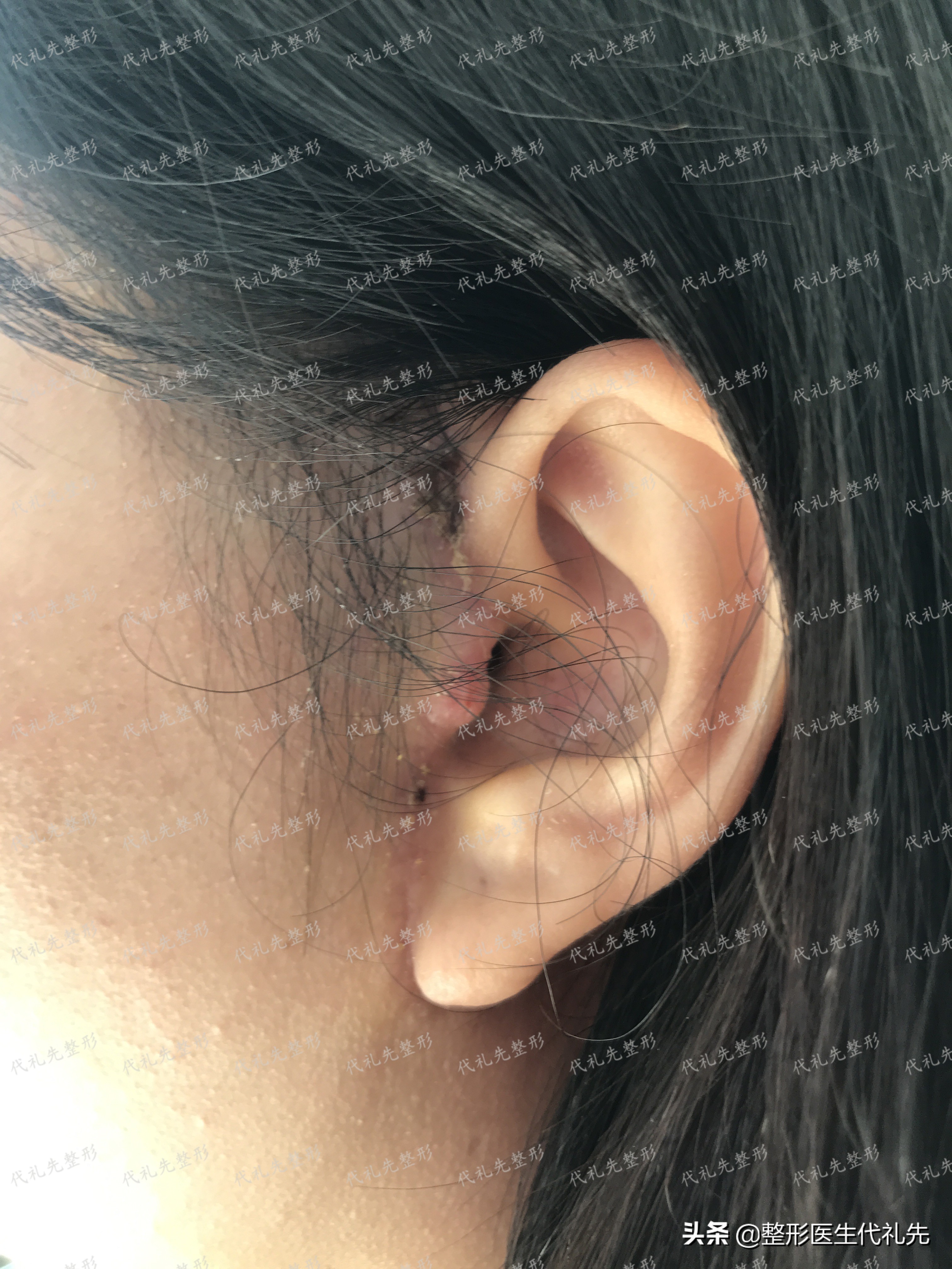 49岁女人做小拉皮术后恢复,50岁女人拉皮手术后脸变化