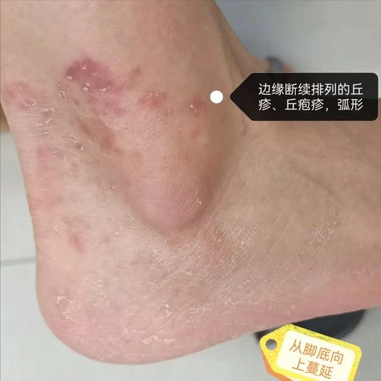 你以为的脚气还不是脚气