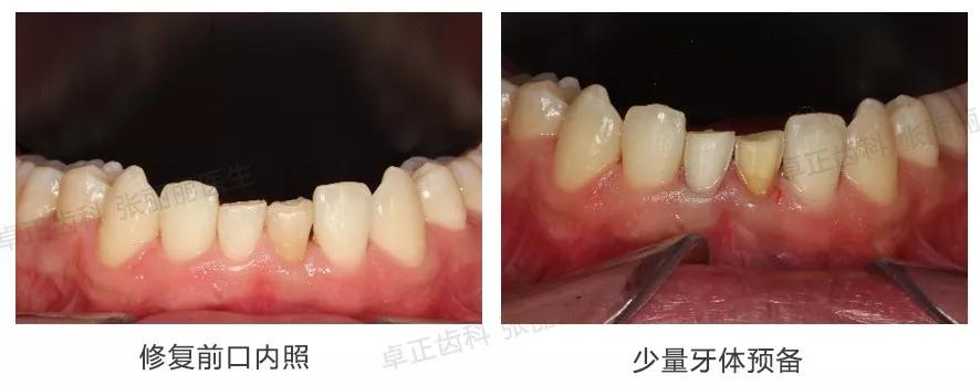 牙齿缺损全瓷冠修复多少钱,牙齿楔状缺损修复大概多少钱