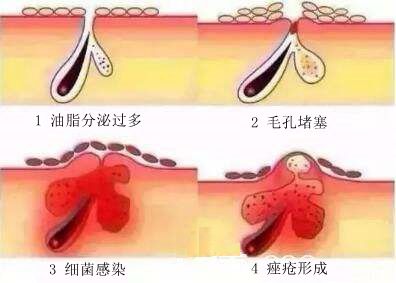 关于各种痘痘的在线咨询,治疗痘痘的分享