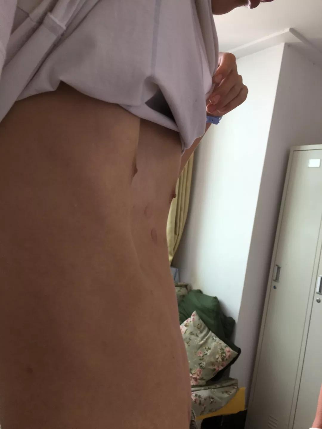 14岁男孩因“漏斗胸”自卑想退学，这是种什么病？