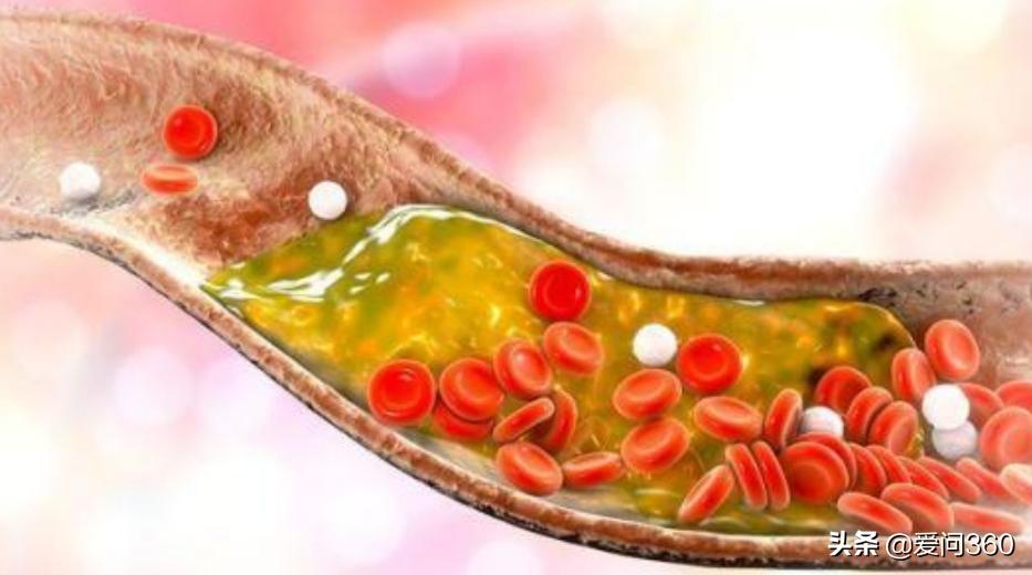 70岁老人血粘度低,老人血粘度偏高怎么调理