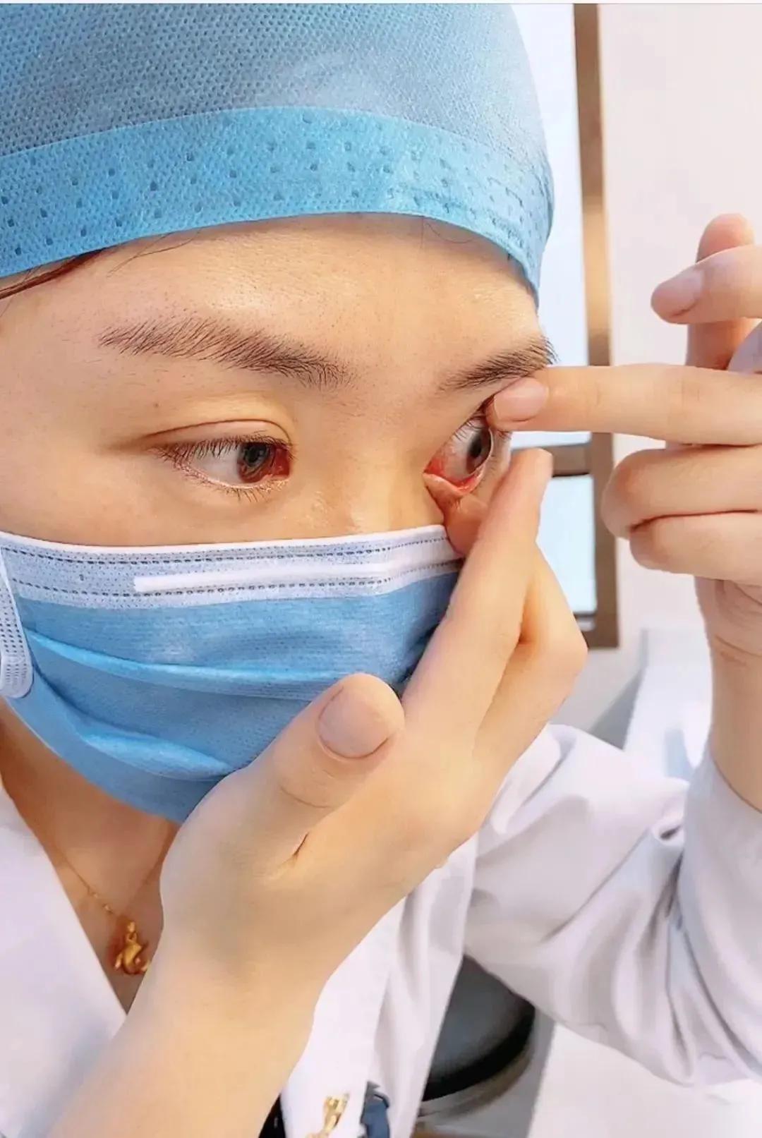 摘隐形眼镜有什么好方法吗,眼科医生告诉你隐形眼镜戴法