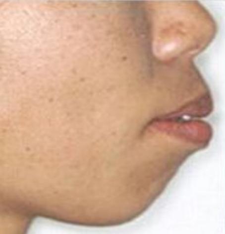 凸嘴皮肤不好怎么逆袭,凸嘴如何逆袭完美侧脸