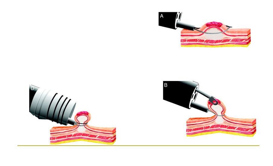 emr和esd消化内镜哪个好,内镜下esd和emr治疗的区别