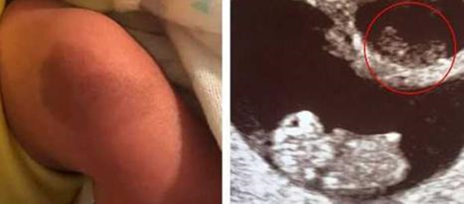 龙凤胎姐姐被抱养,双胞胎妹妹身上有胎记