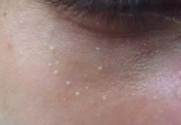 闭合性粉刺的正确消除方法,阿司匹林祛除闭合性粉刺