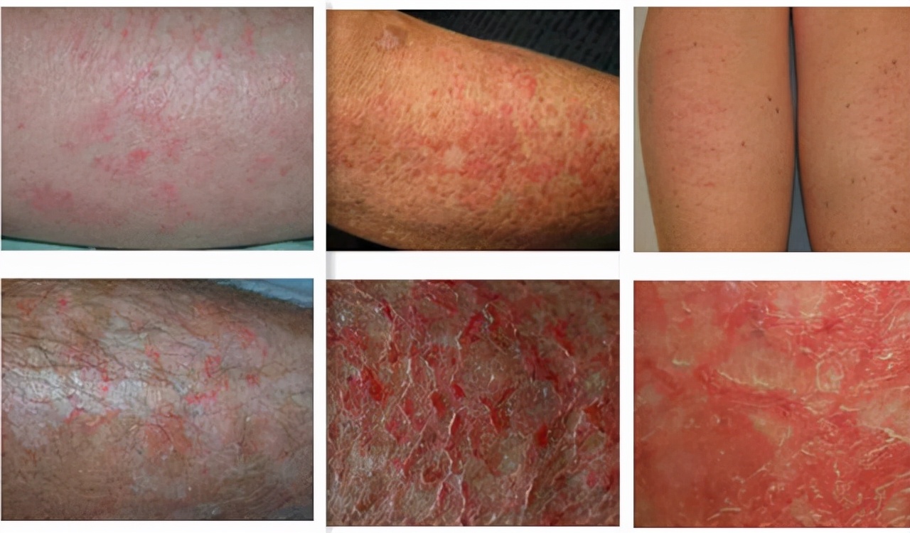 各种皮炎是哪些皮炎呢,得了皮炎需要注意什么