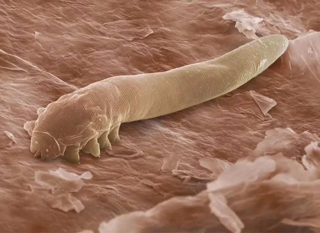 螨虫引起的视力模糊能恢复吗,眼睛查出5条螨虫