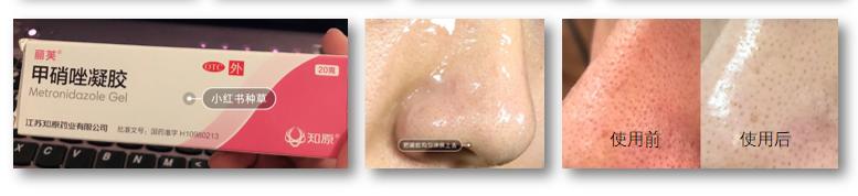 药店去黑头的6种药膏国货,用手挤黑头的护肤品